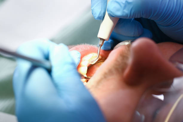 Best Emergency Tooth Extraction in Georgetown, KY